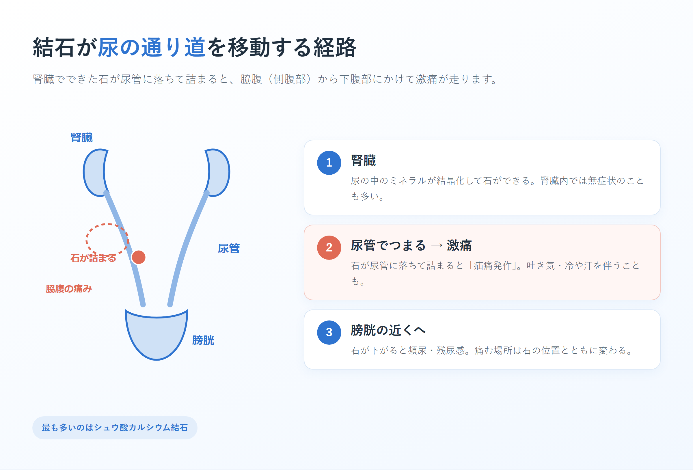 尿路結石が腎臓から尿管・膀胱へ移動する経路と、脇腹の痛みの部位を示した図解