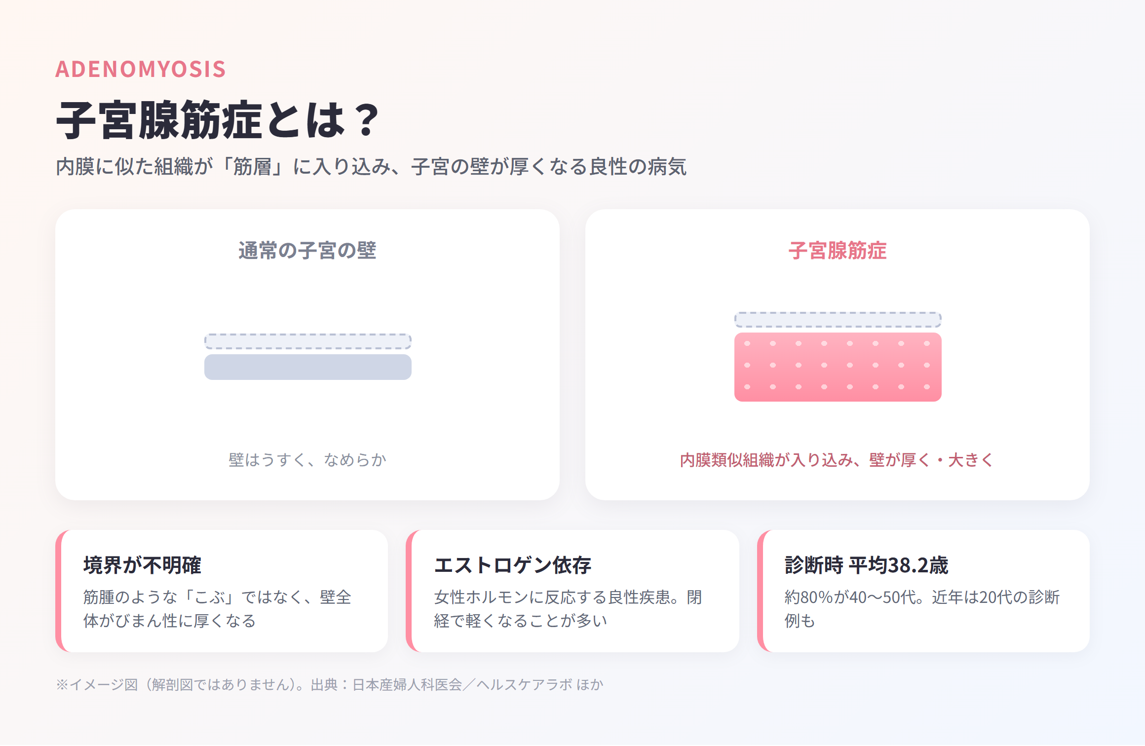 通常の子宮の壁と、内膜に似た組織が筋層に入り込んで壁が厚くなった子宮腺筋症の状態を並べたイメージ図
