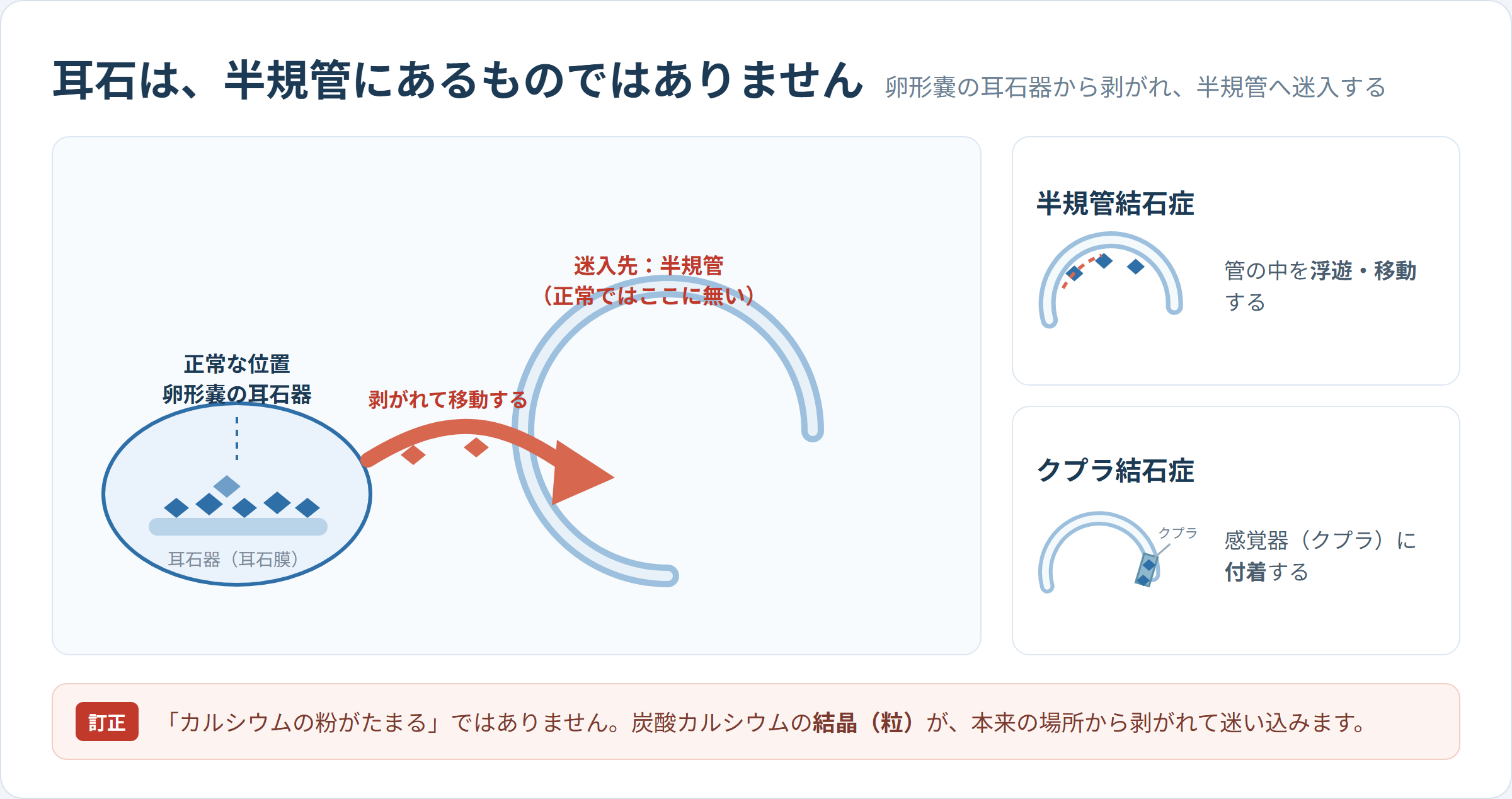 耳石の迷入を示す内耳の模式図。左の卵形嚢の耳石器に炭酸カルシウムの結晶があり、矢印で半規管へ移動する経路を示す。半規管側には「正常ではここに無い」と注記し、右に半規管結石症とクプラ結石症の小図