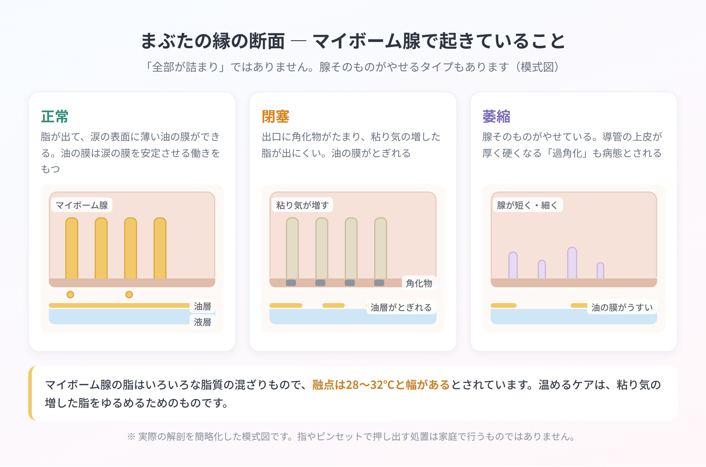 まぶたの縁の断面を正常・閉塞・萎縮の3パネルで比べた模式図。正常は脂が出て涙の表面に油層ができ、閉塞は出口に角化物がたまって油層がとぎれ、萎縮は腺そのものが短く細くなっている。脂の融点は28〜32℃と幅があると注記