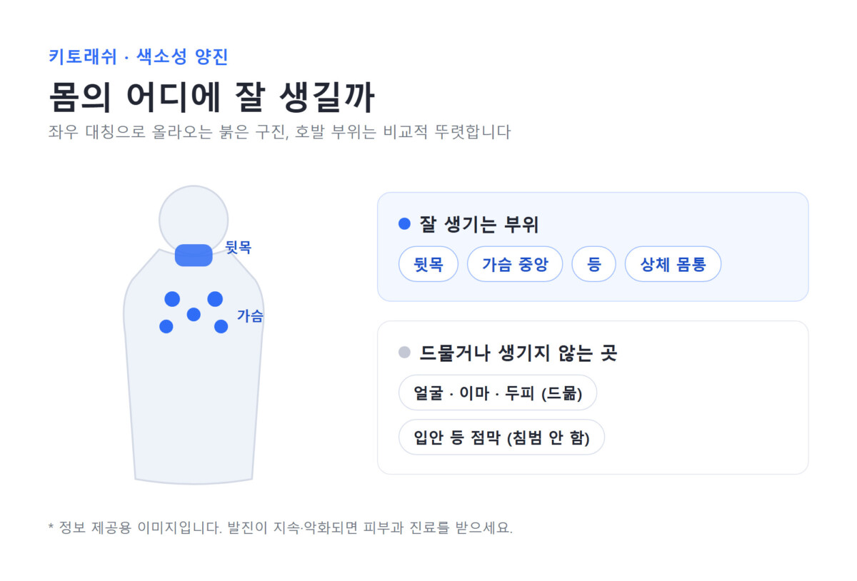 키토래쉬가 잘 생기는 부위를 나타낸 지도 - 뒷목·가슴 중앙·등·상체 몸통은 호발, 얼굴·두피·점막은 드묾