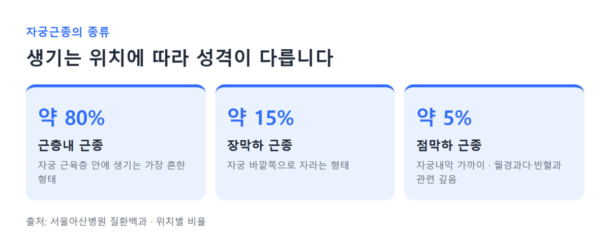 자궁근종의 위치별 종류(근층내 약 80%·장막하 약 15%·점막하 약 5%)를 정리한 도식