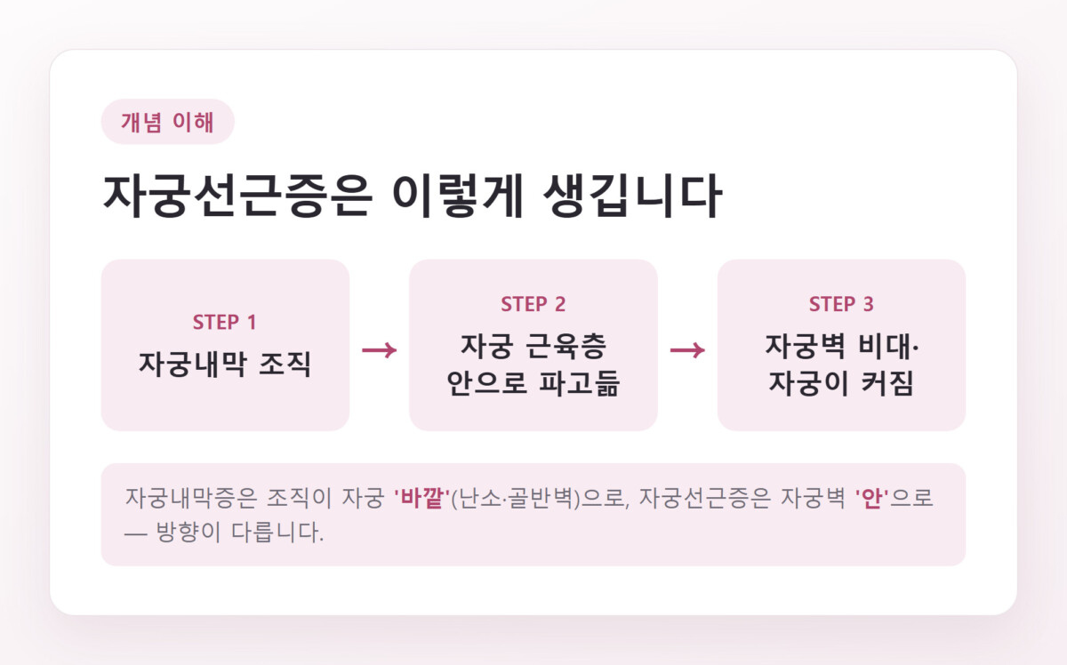 자궁내막 조직이 자궁 근육층 안으로 파고들어 자궁벽이 두꺼워지는 과정을 3단계로 정리한 개념도