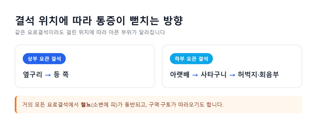 상부 요관·하부 요관 결석 위치별로 통증이 뻗치는 방향을 비교한 다이어그램