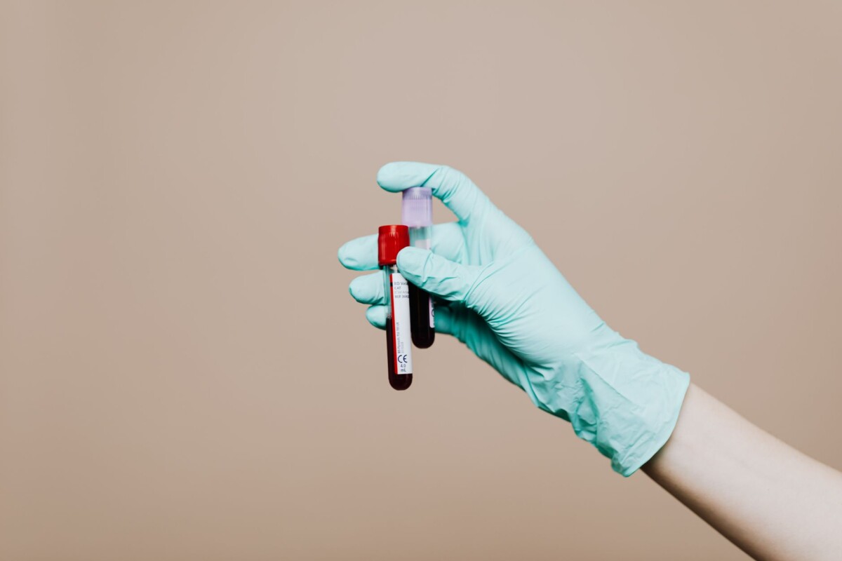 동물병원에서 채혈한 혈액이 담긴 검사용 시험관 — 항체가 검사