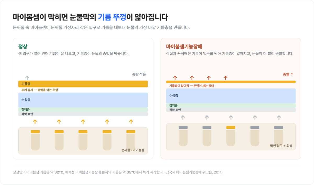 정상 눈꺼풀과 마이봄샘기능장애 눈꺼풀을 좌우로 비교한 도해 — 막힌 샘 입구와 얇아진 눈물막 기름층