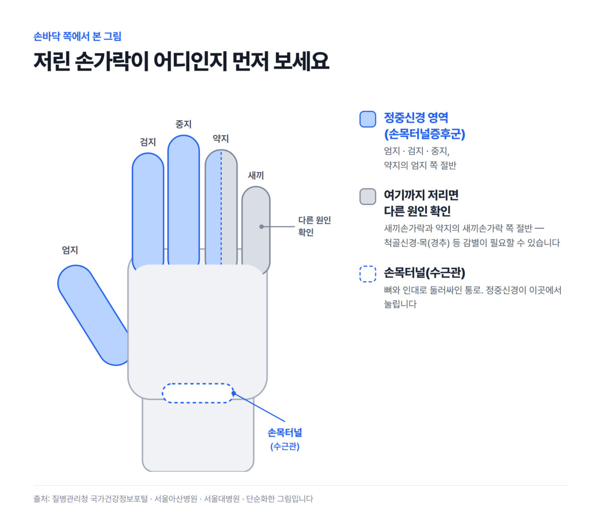 손바닥 쪽 손 그림에서 엄지·검지·중지와 약지의 엄지 쪽 절반을 정중신경 영역(손목터널증후군)으로 파랗게, 새끼손가락과 약지의 새끼손가락 쪽 절반을 회색 '다른 원인 확인' 영역으로 표시하고 손목에 손목터널(수근관)을 표시한 그림