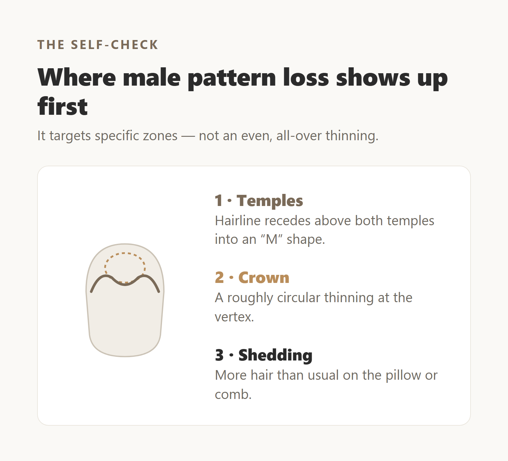 Diagram of where male pattern hair loss shows up first: temples, crown, and shedding