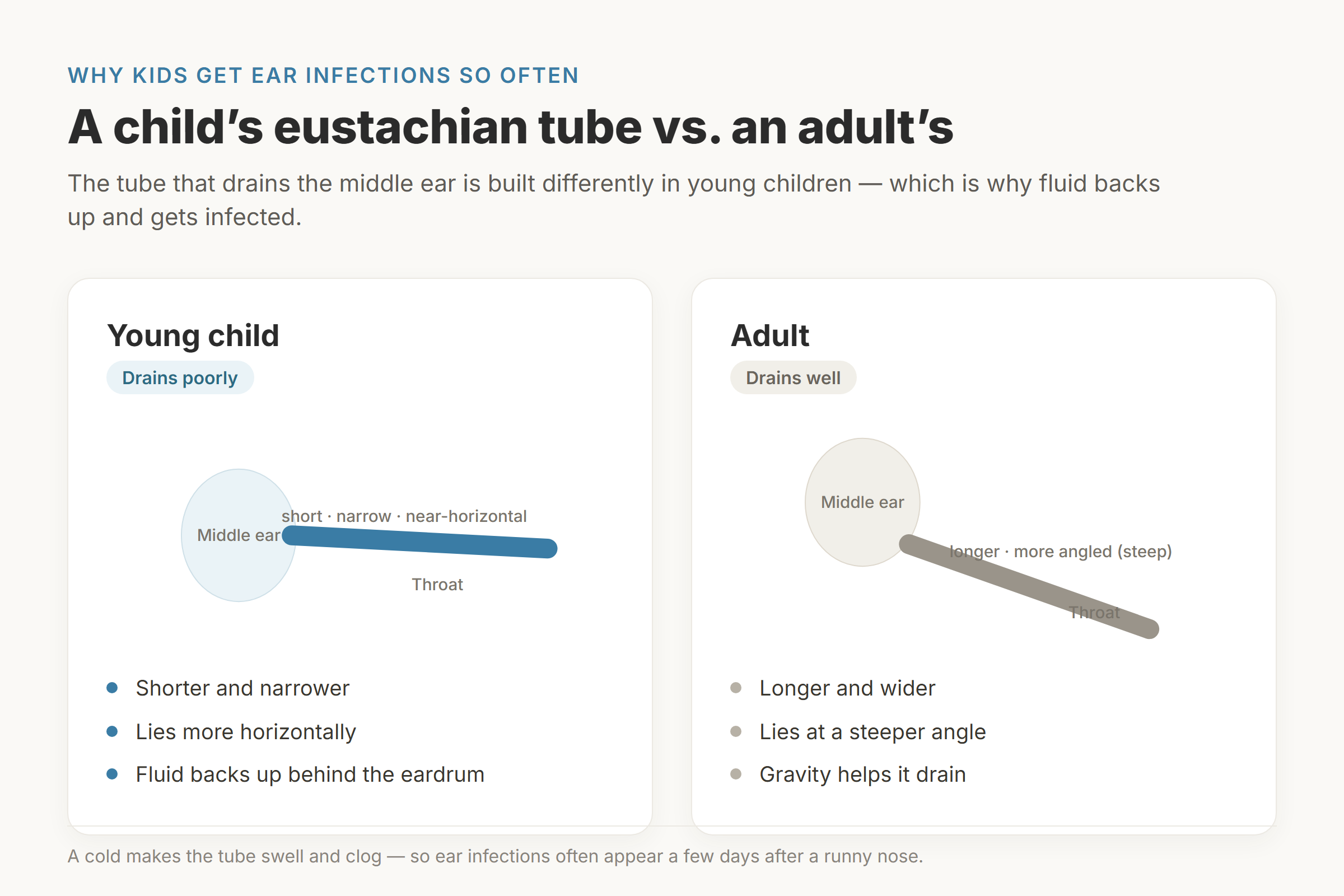 Diagram comparing a young child's short, narrow, near-horizontal eustachian tube with an adult's longer, steeper tube, showing why children's ears drain poorly