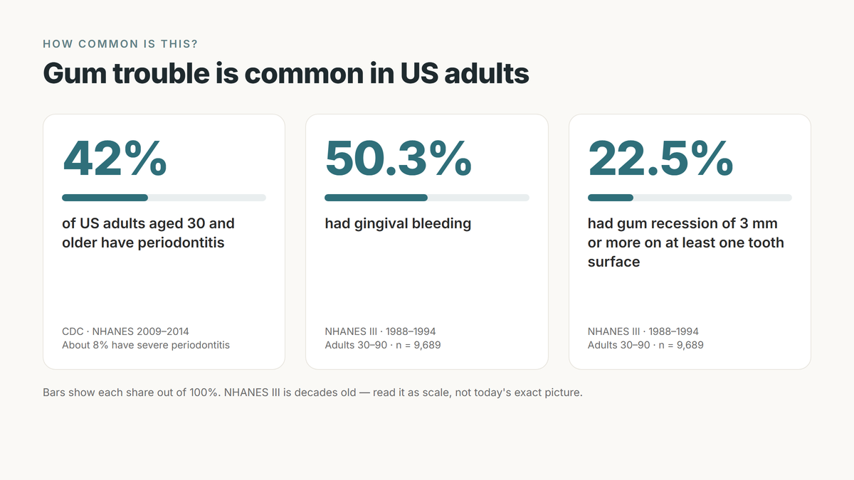 Data card on US gum health: 42 percent of adults 30 and older have periodontitis (CDC, NHANES 2009–2014); in NHANES III, 1988–1994, 50.3 percent had gingival bleeding and 22.5 percent had gum recession of 3 mm or more on at least one tooth surface
