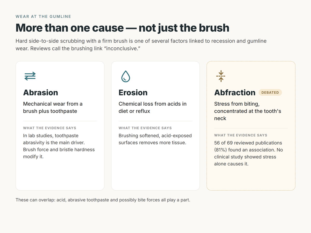 Comparison card of three kinds of wear at the gumline: abrasion from brush plus toothpaste, erosion from acids, and abfraction from bite stress, which is marked as debated
